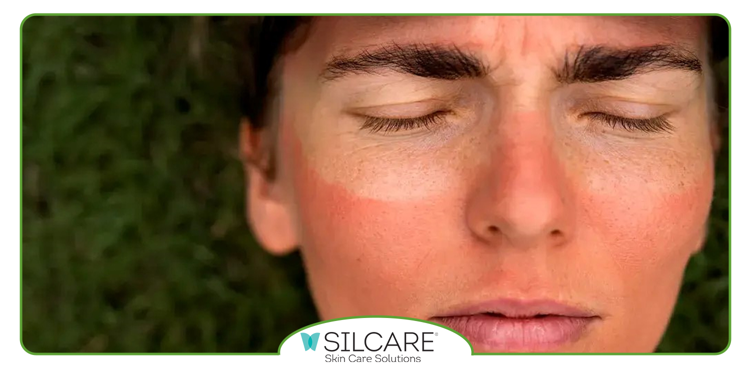 استفاده از اسپری آفتاب سوختگی و سولار