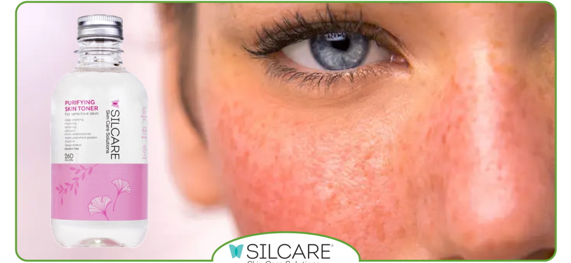ترکیبات تونر که التهاب و قرمزی پوست حساس را کاهش می‌ دهند