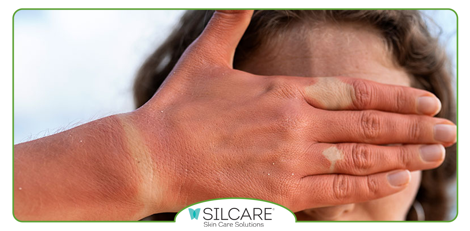 اسپری ضد آفتاب سیلکر چه کاربردی دارد؟