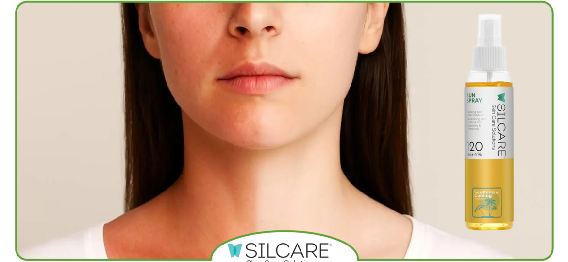 راهنمای استفاده از اسپری آفتاب‌ سوختگی بعد از قرار گرفتن در آفتاب شدید