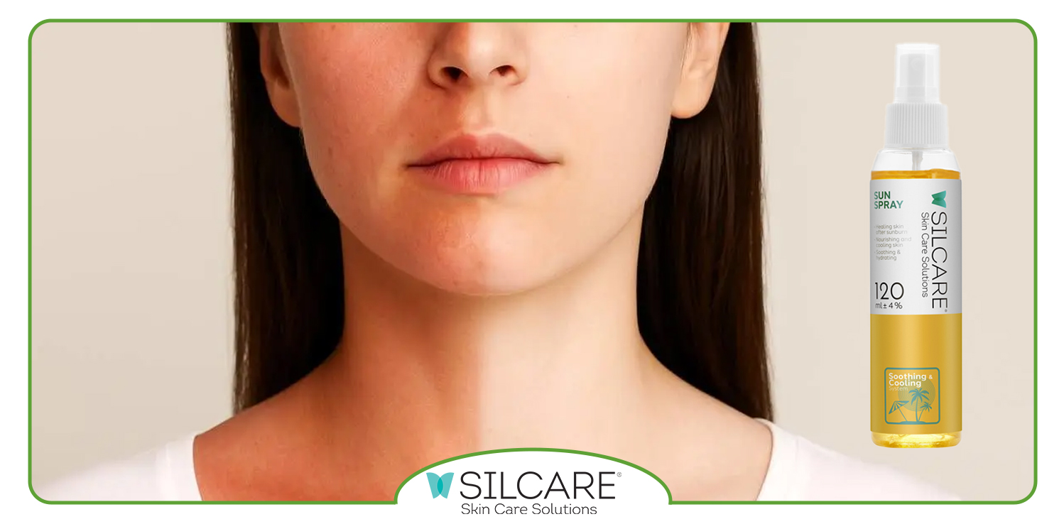 راهنمای استفاده از اسپری آفتاب‌ سوختگی بعد از قرار گرفتن در آفتاب شدید