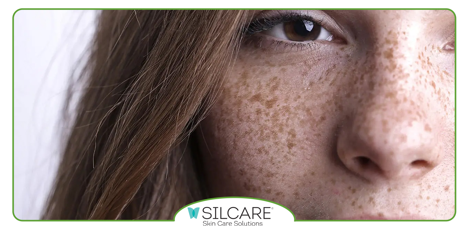 سرم ضد لک و روشن کننده