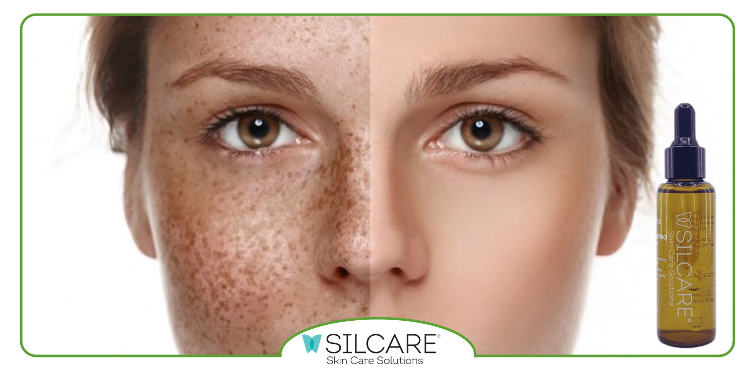 شناسایی نوع لک و علت آن