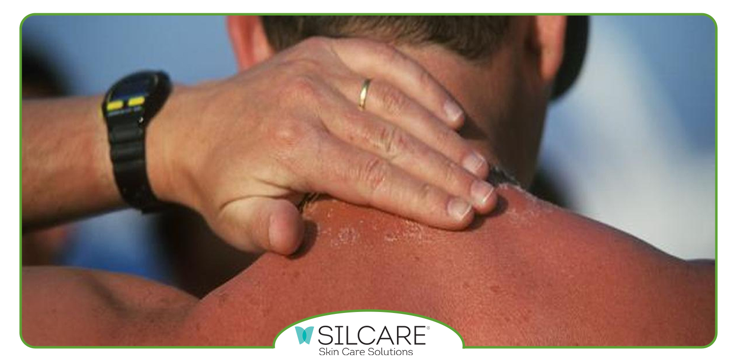 مراقبت‌ های ضروری بعد از آفتاب‌ سوختگی