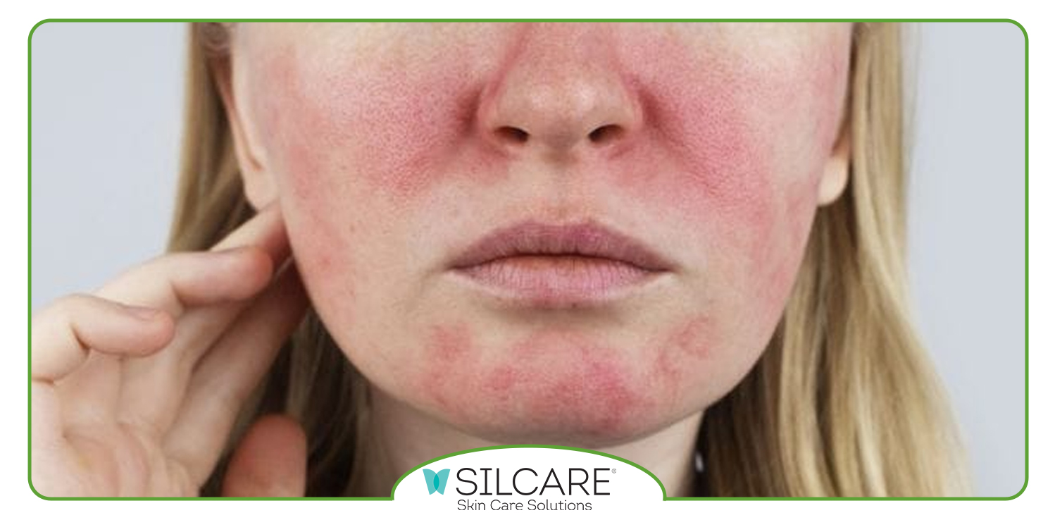 ویژگی تونر مخصوص پوست حساس سیلکر