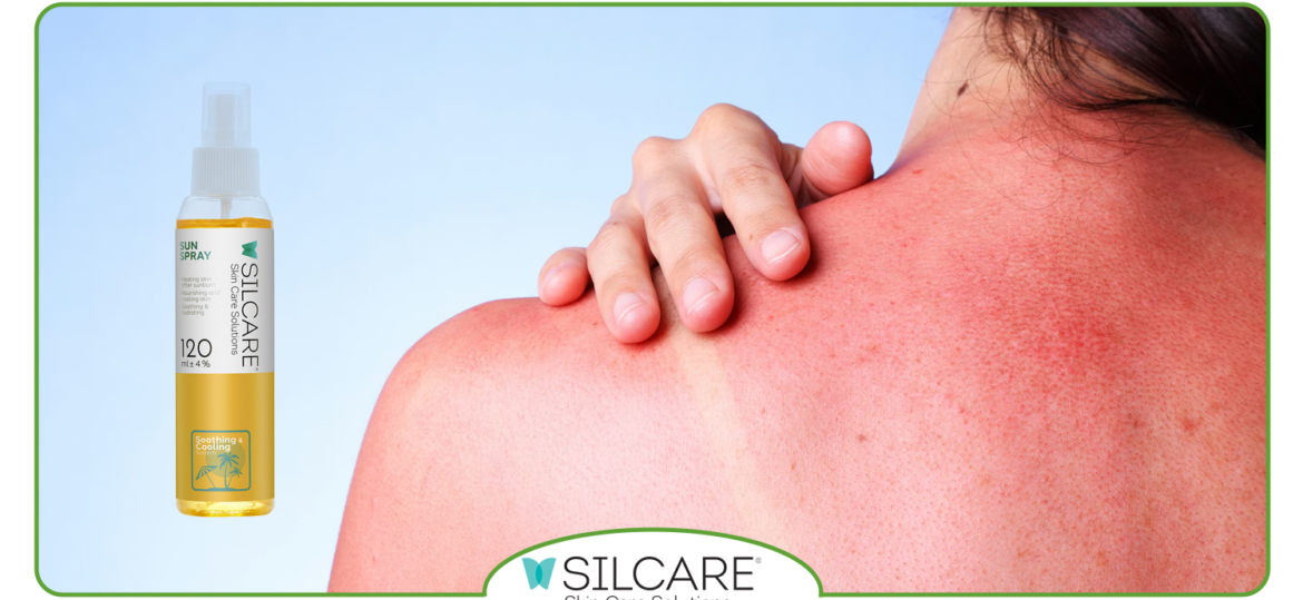 آفتاب سوختگی