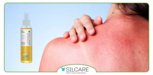 تفاوت اسپری آفتاب سوختگی و کرم های التیام بخش