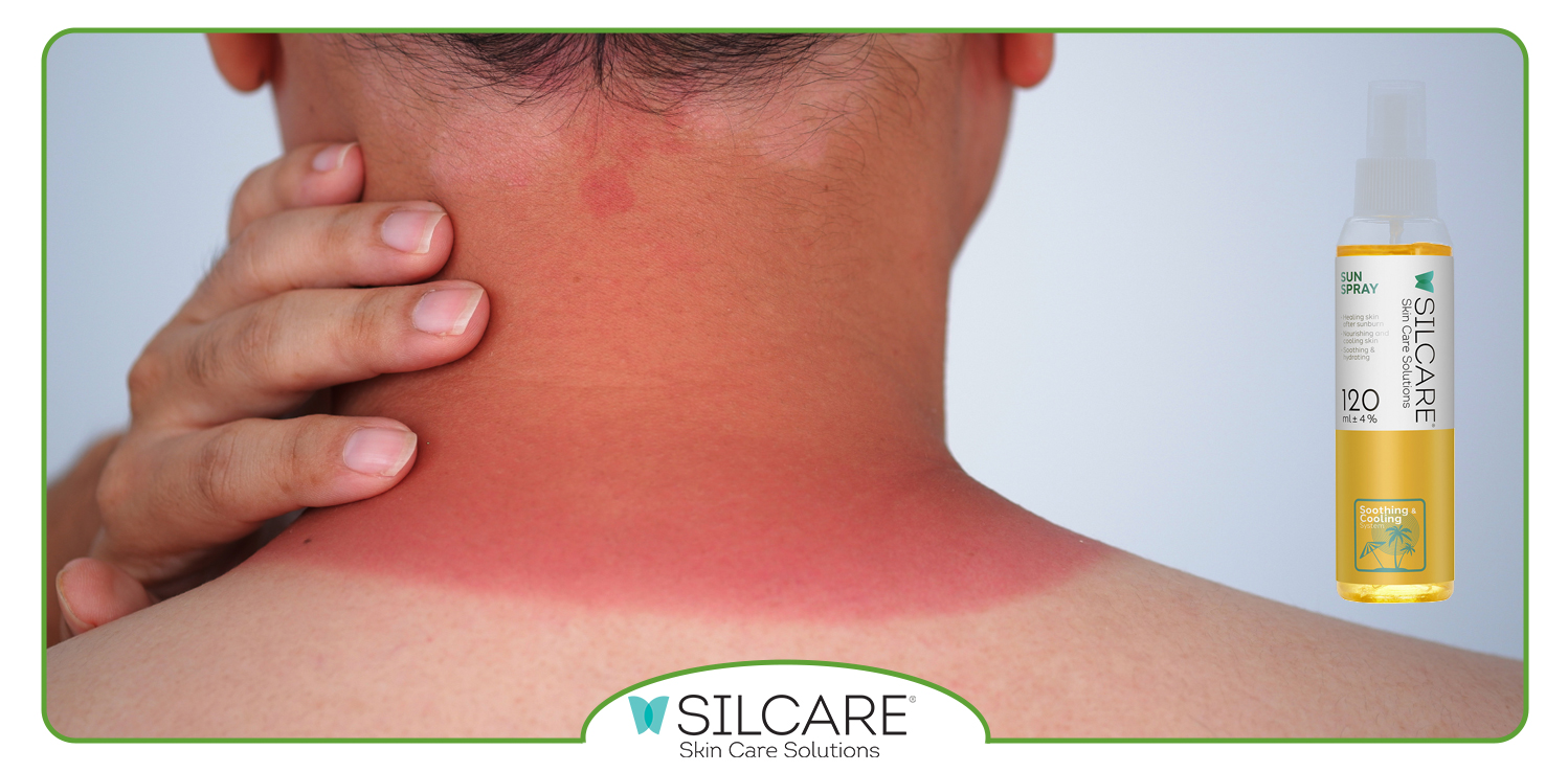 آفتاب سوختگی