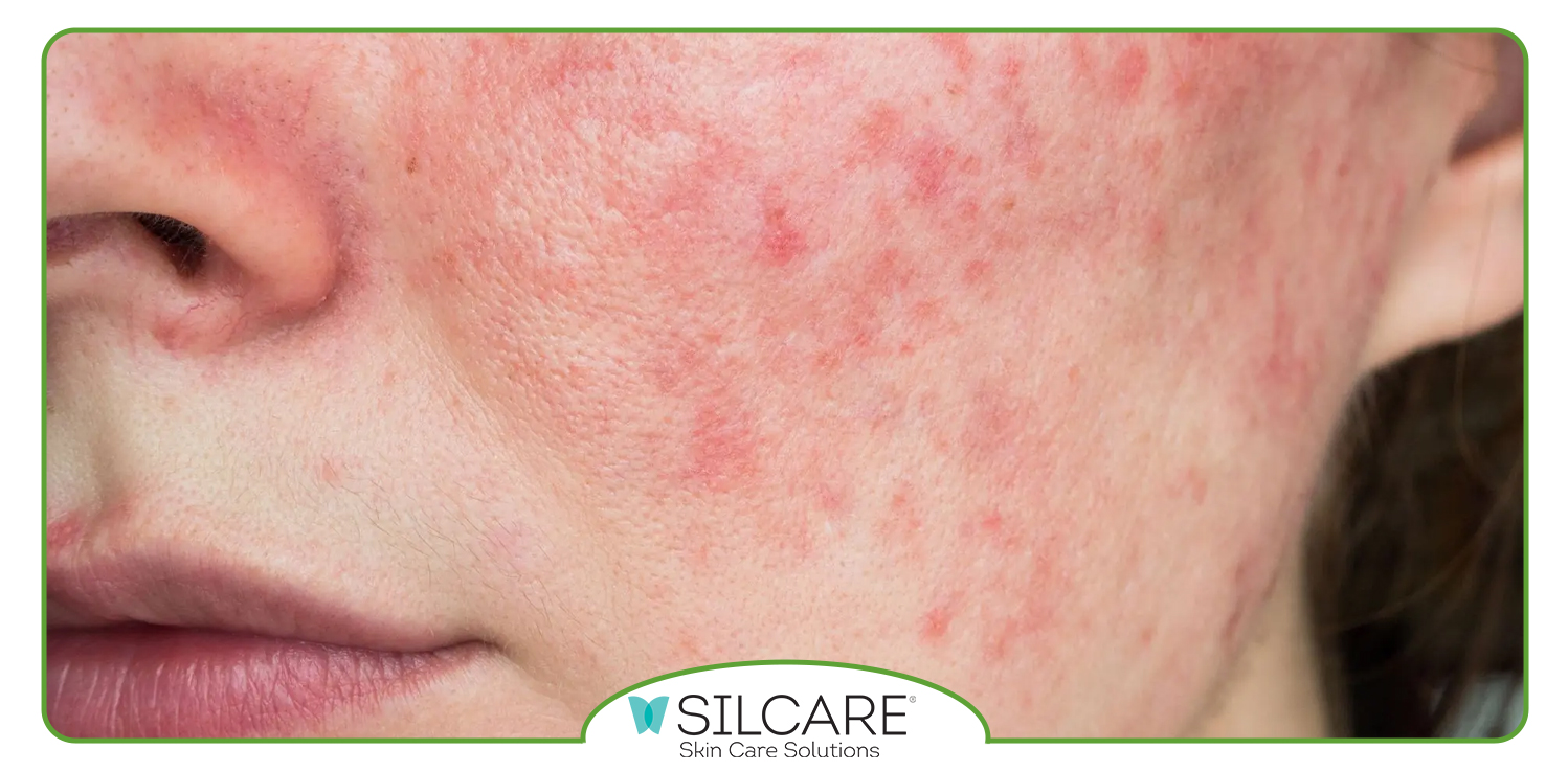 آفتاب سوختگی