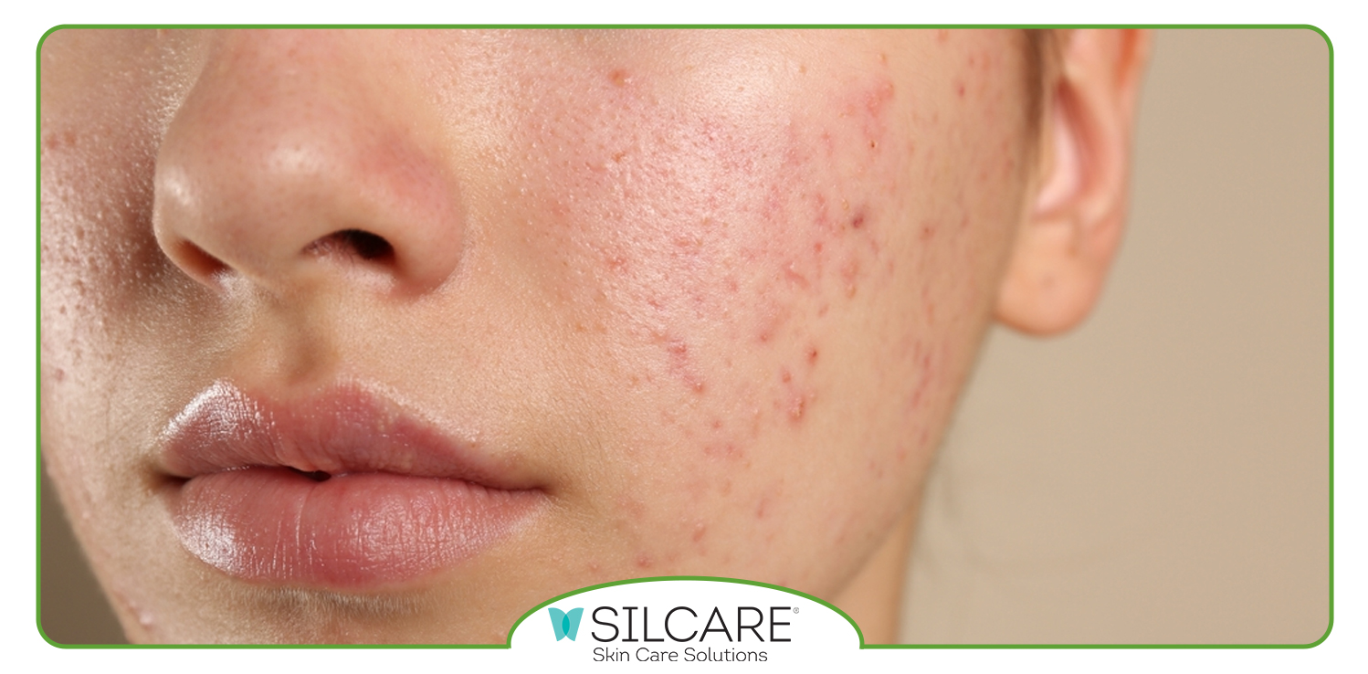 با محصولات ضد جوش که قدرت کمتری دارند شروع کنید