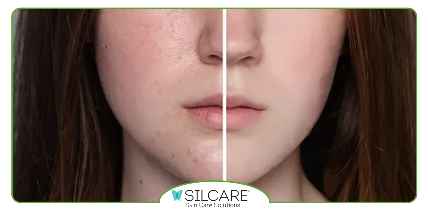 تونر مناسب پوست خشک