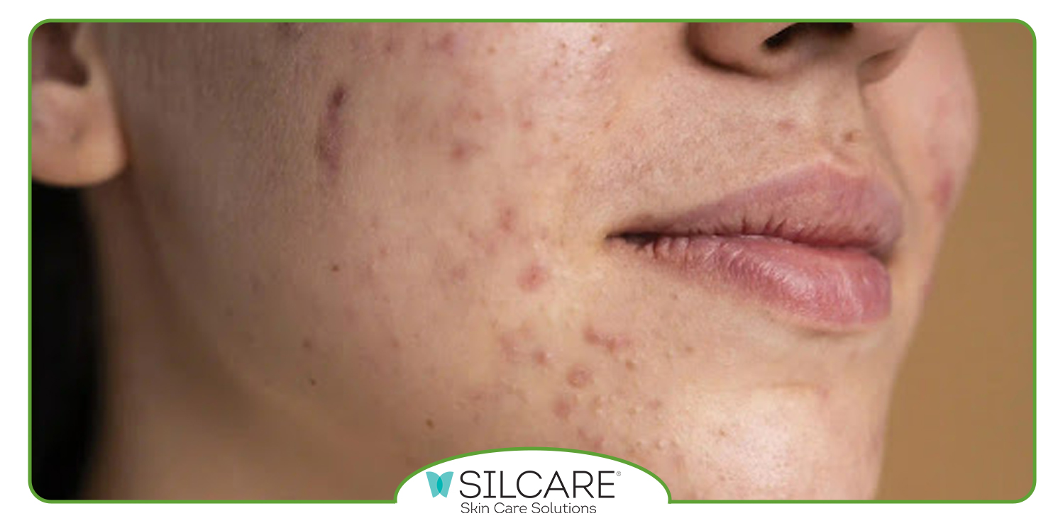 روتین چهار مرحله ای شستشو با سرم کنترل چربی سیلکر