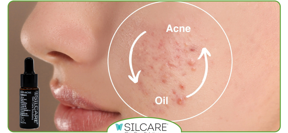 روتین-۴-مرحله-‌ای-با-سرم-کنترل-چربی-برای-پوست-جوش‌-دار