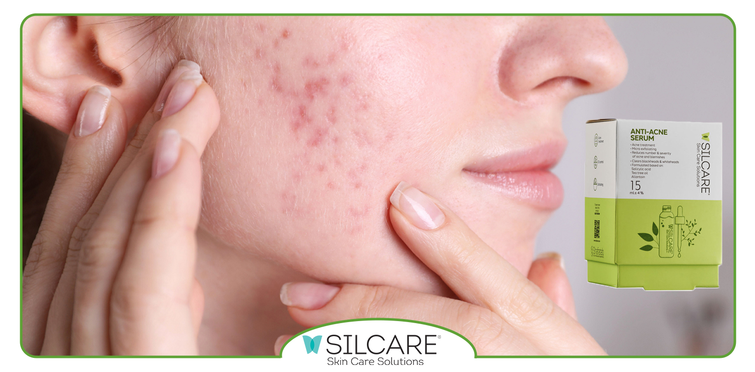 روغن درخت چای چه تاثیری در جوش های پوست دارد؟