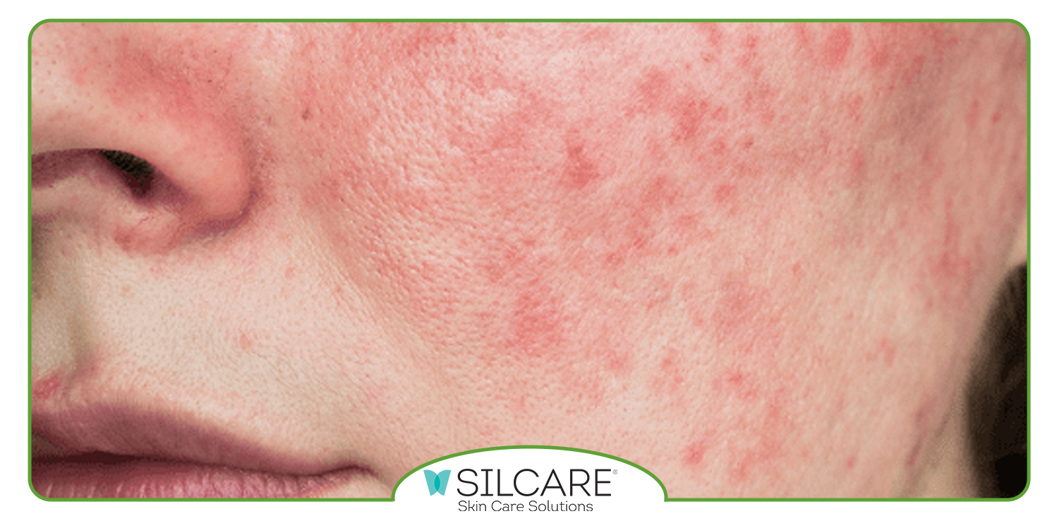 ویژگی‌ های ترمیم کننده سیلکر برای قرمزی صورت