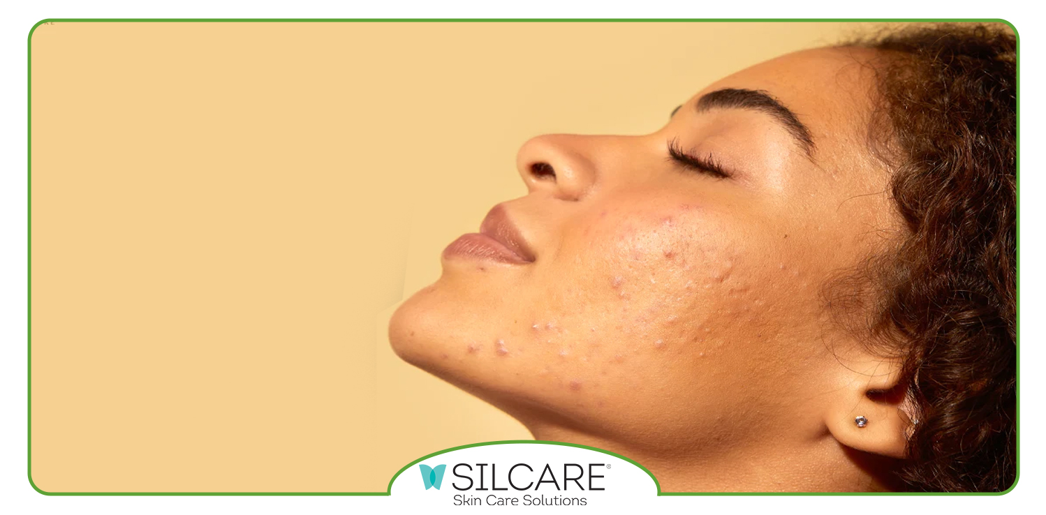 ویژگی‌ های ژل شستشوی مناسب صورت چرب و جوش ‌دار